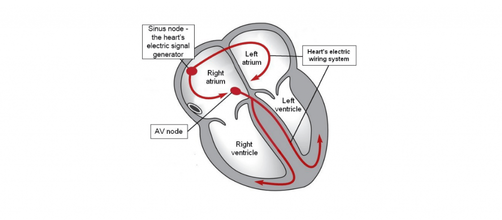 Arrhythmias