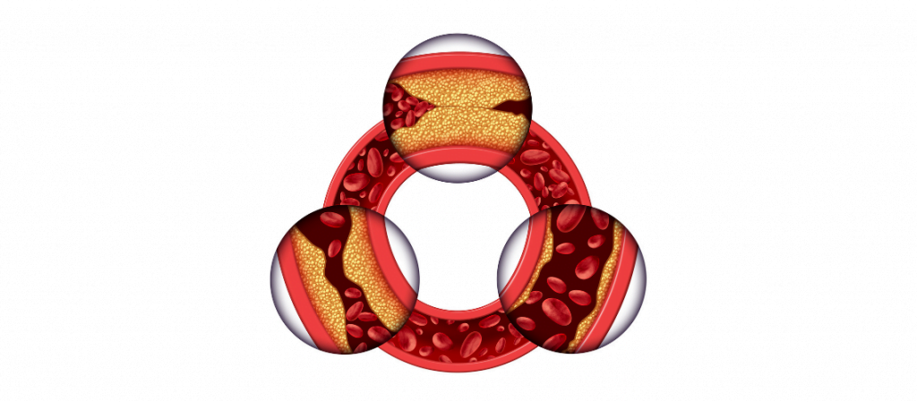 Coronary heart disease